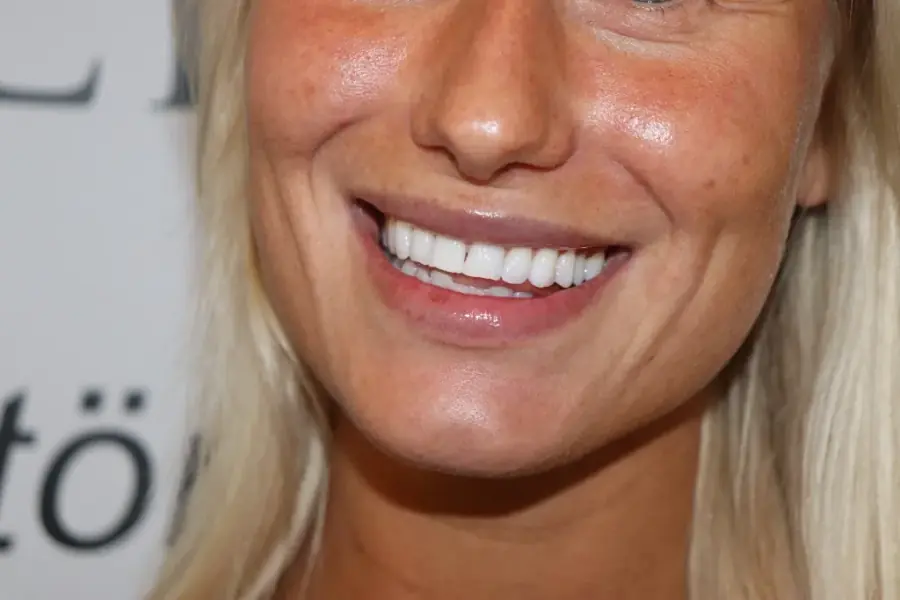 Vitare leende efter Brilliant Smile-behandling